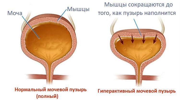 Туалетные привычки для здоровья тазового дна и мочевого пузыря