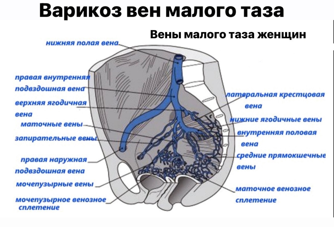 Варикоз: причины и профилактика