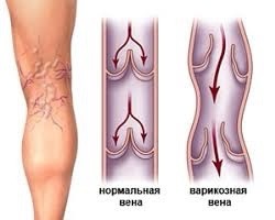 Варикоз: причины и профилактика