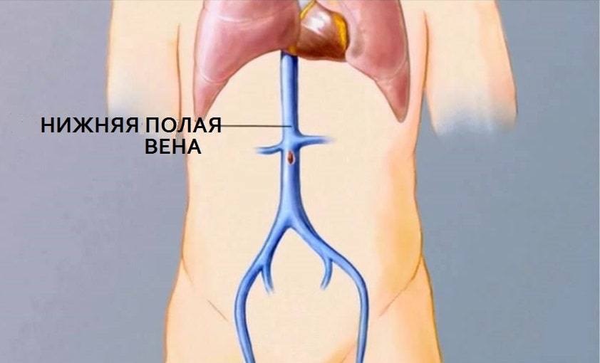 Варикоз: причины и профилактика