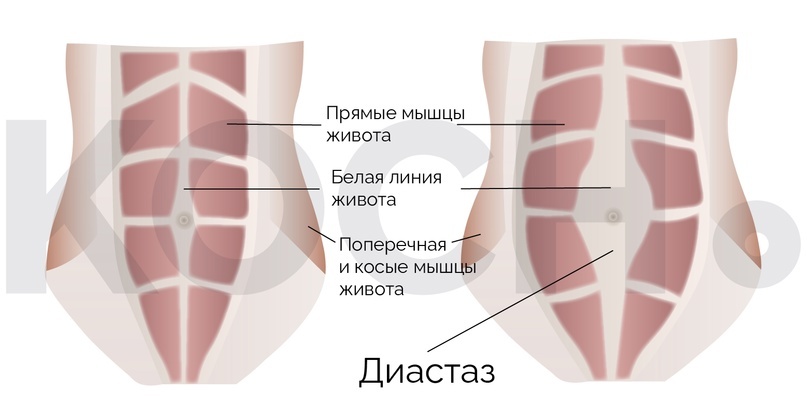 Диастаз. Что делать?