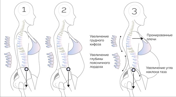 Диастаз. Что делать?