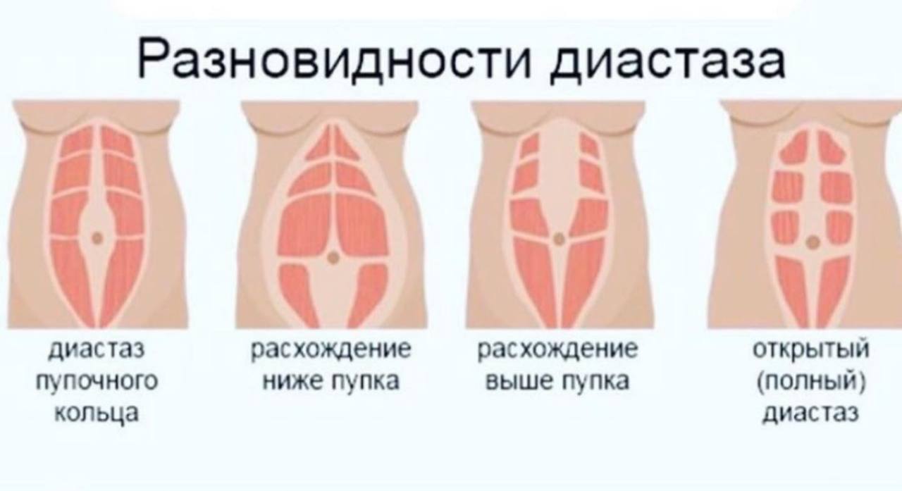 Диастаз