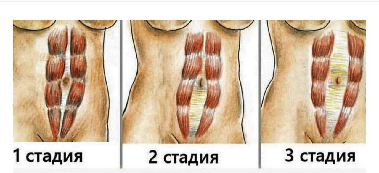 Диастаз