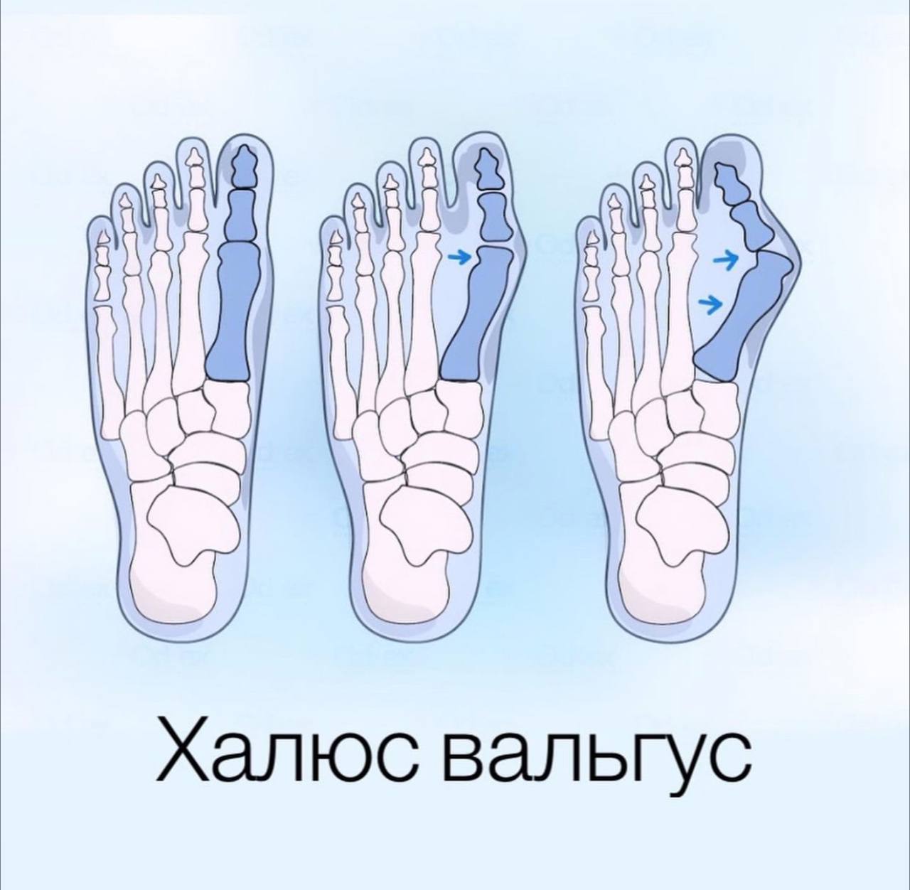 Стопа, теория + тейпирование
