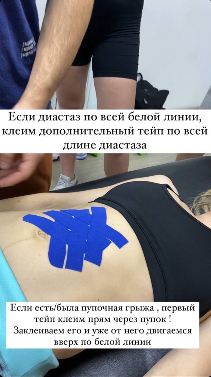 Тейпирование диастаза