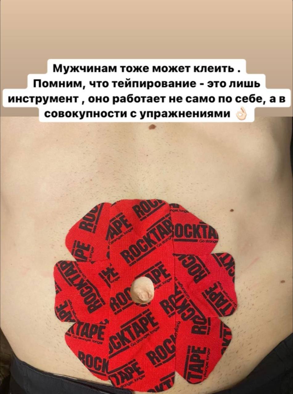 Тейпирование: Пупочное кольцо