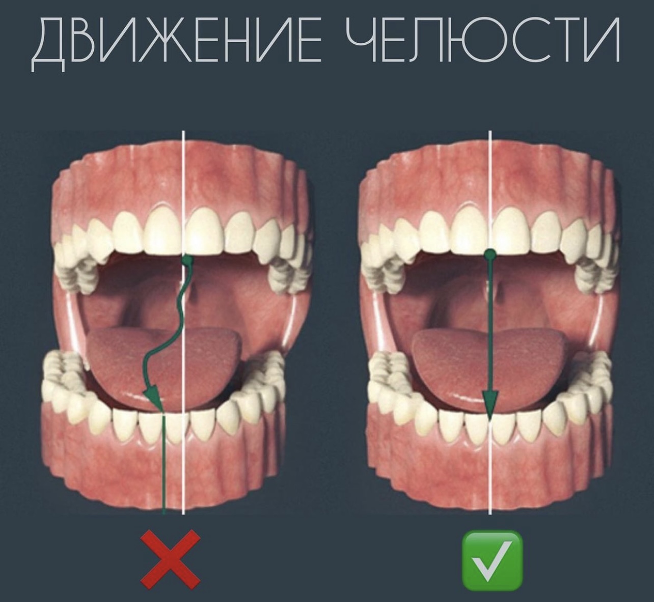 Височно-нижнечелюстной сустав (ВНЧС)